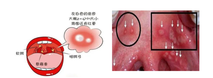 家长注意！得了这种病，孩子高烧、疼得水都喝不下，一定要学会预防