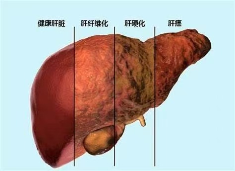2+3健康服务包 | 警惕常见肝病--乙肝