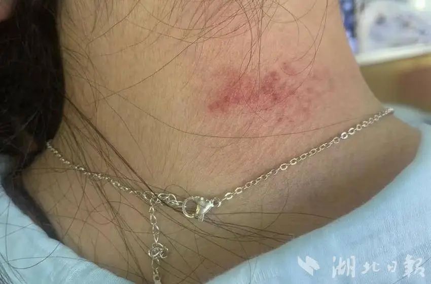 高毒性重金属超标！夏季高发！医生提醒：不要长时间佩戴