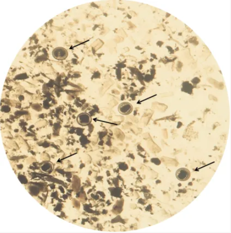 螃蟹不能这样吃！有人因此肺、肝等多个器官都坏了！