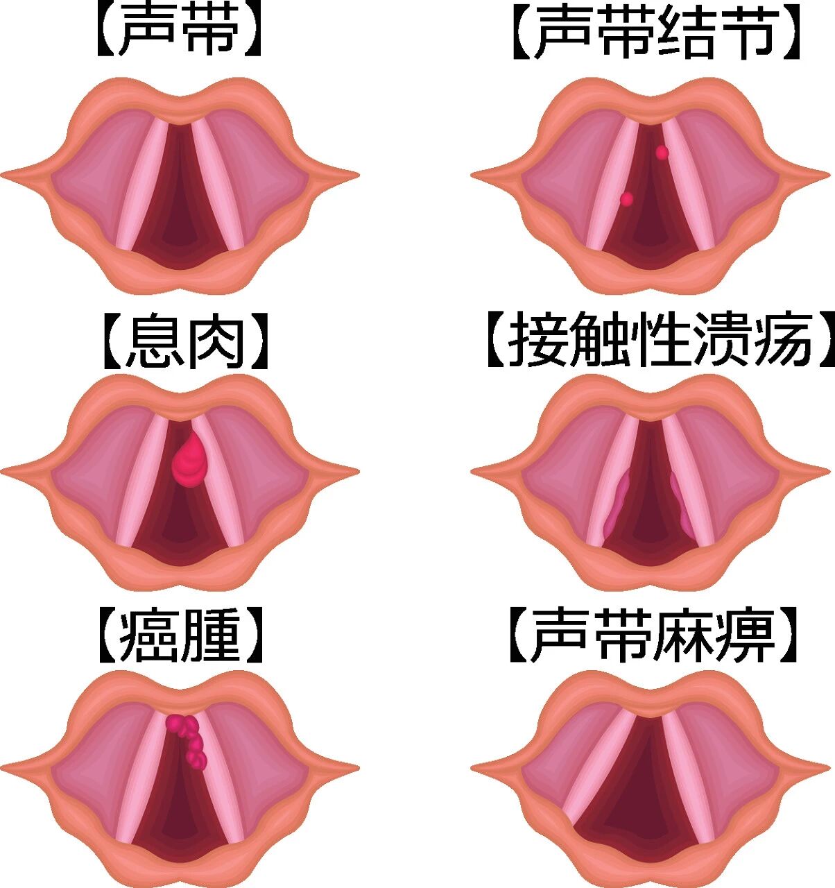 声带息肉图片 声带息肉图片