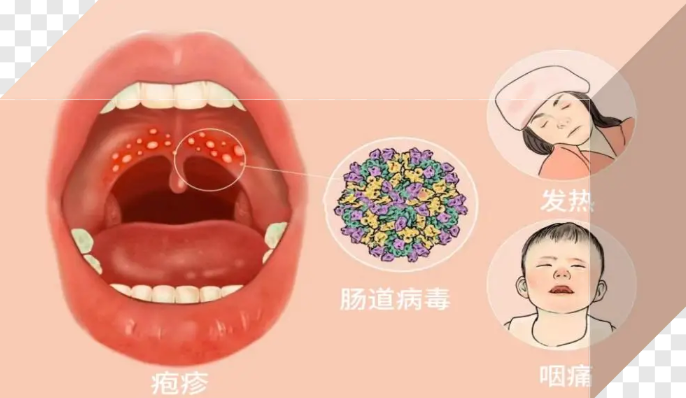 孩子嘴里长疱疹就是得了手足口病？不一定，别忽略它→